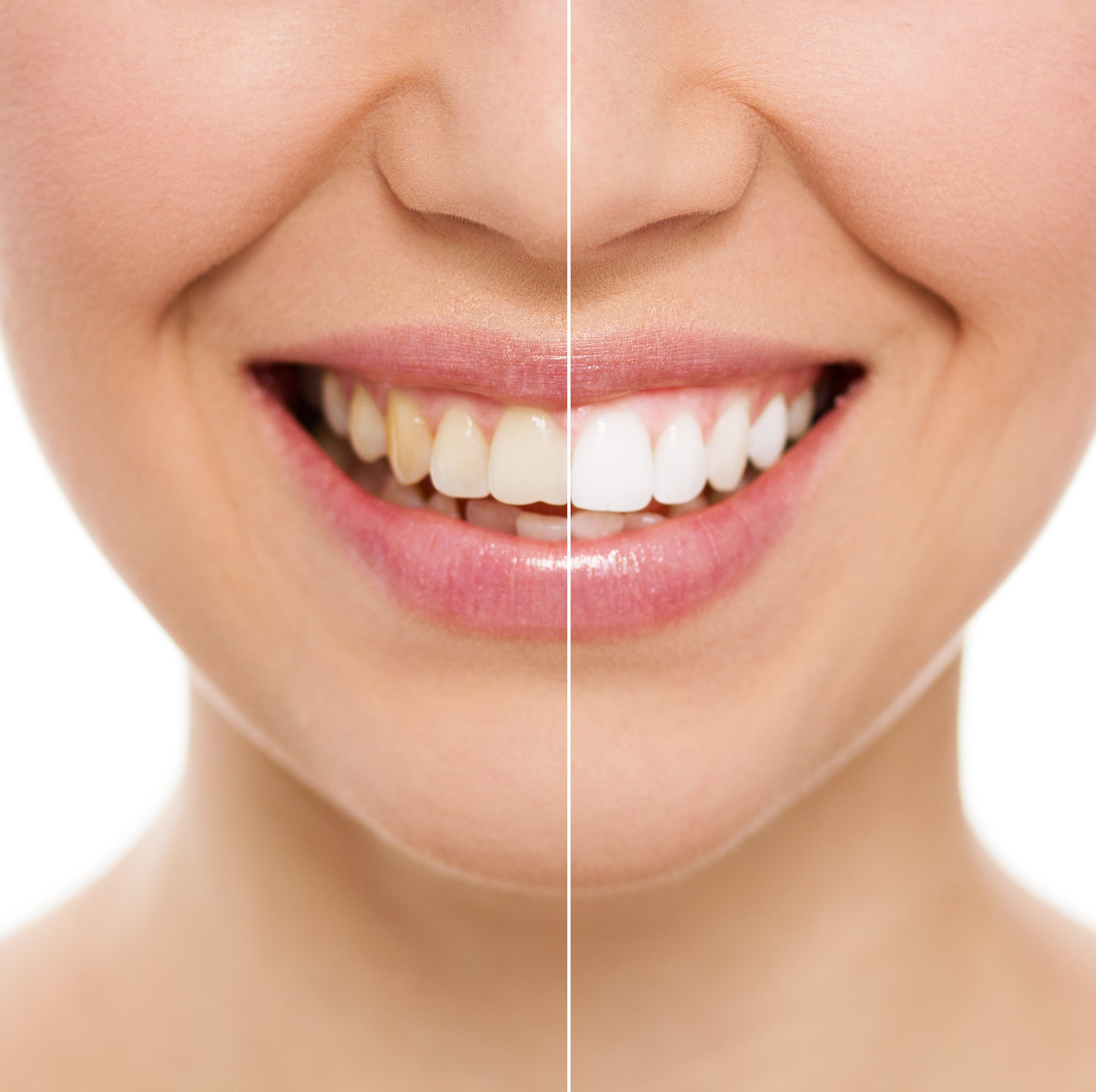Before and after a cosmetic dentistry procedure
