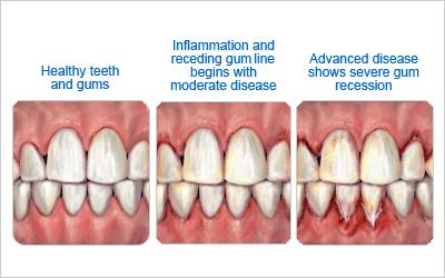 Example of gum disease treated by a periodontist.