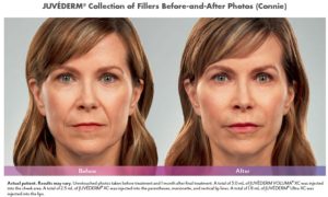 Juvederm treatment before and after photos