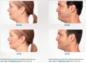 Kybella treatment before and after photos