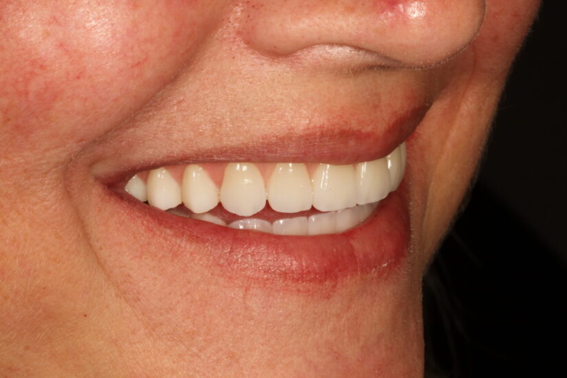 Dentures & Implant Supported Dentures Vancouver WA Dr. Bowyer