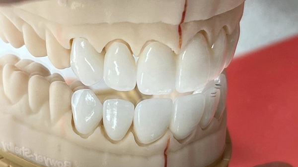 Dental Implants Saratoga Springs Ny