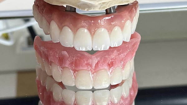 implant supported dentures example