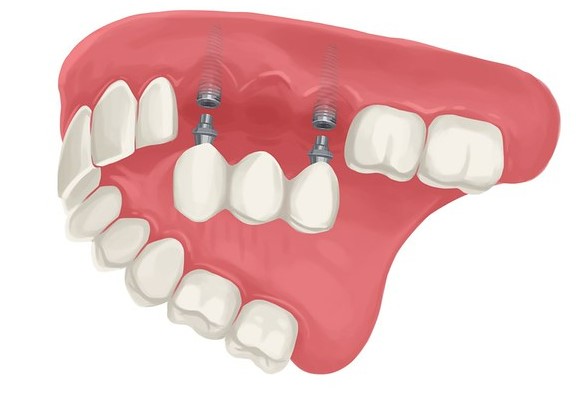 An implant supported dental bridge.