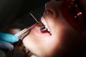 Chipped tooth repair in Vancouver, Washington